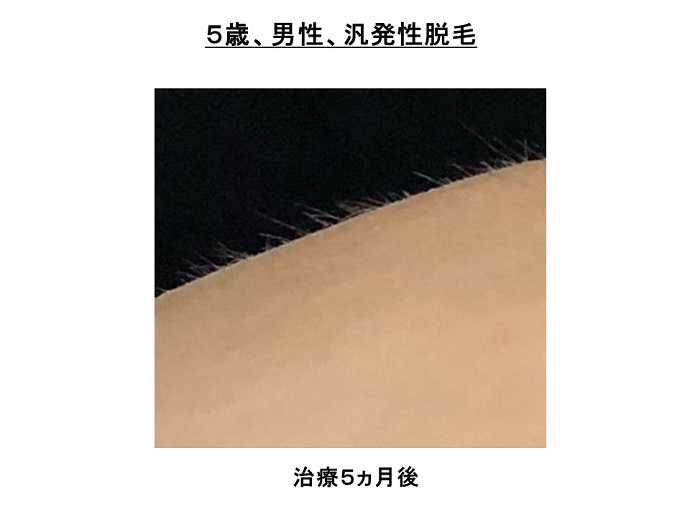 円形脱毛症　病院